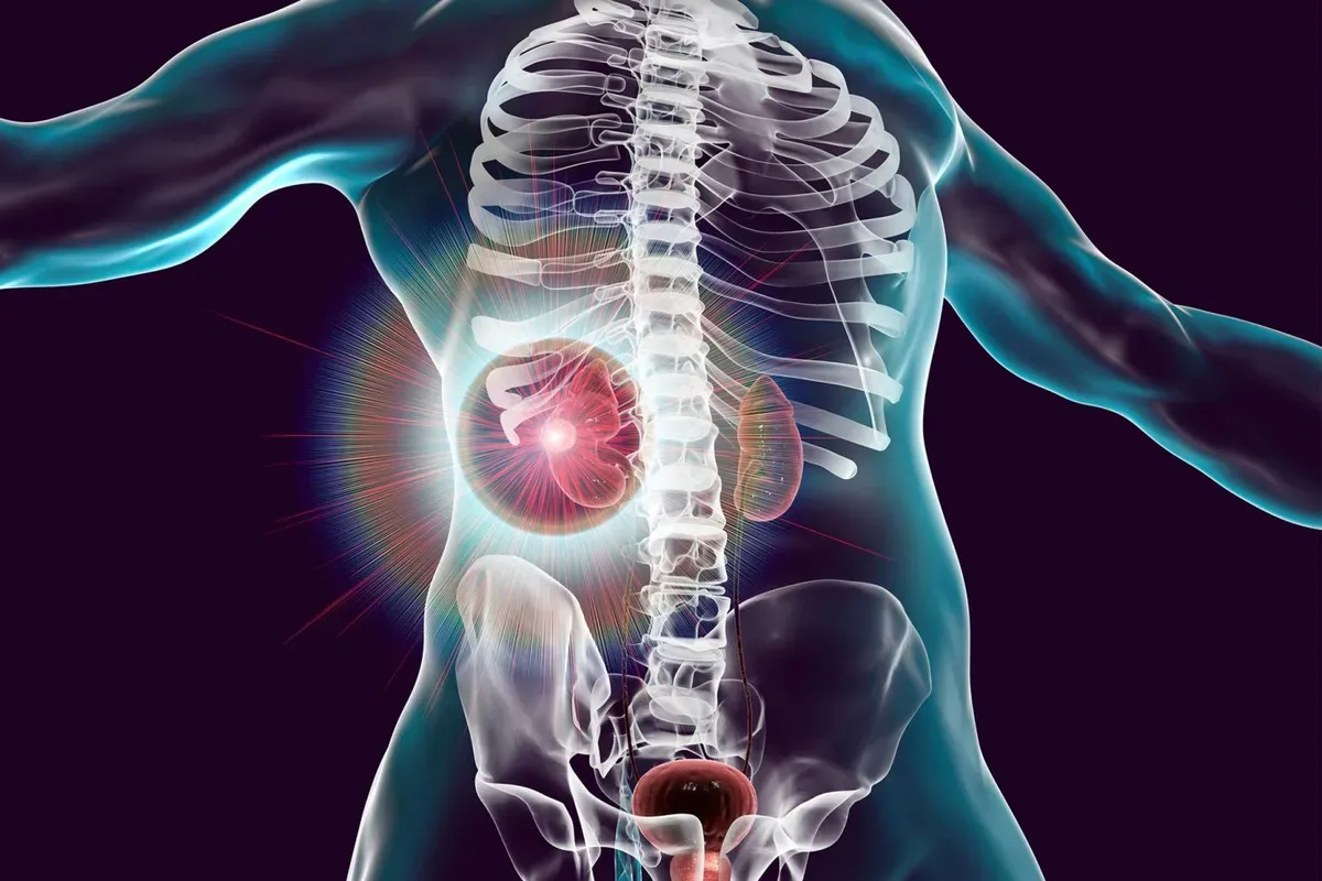 Kidney-Cancer-Treatment-Concept-1536x1024