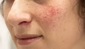 Tips To Getting Your Rosacea Under Control