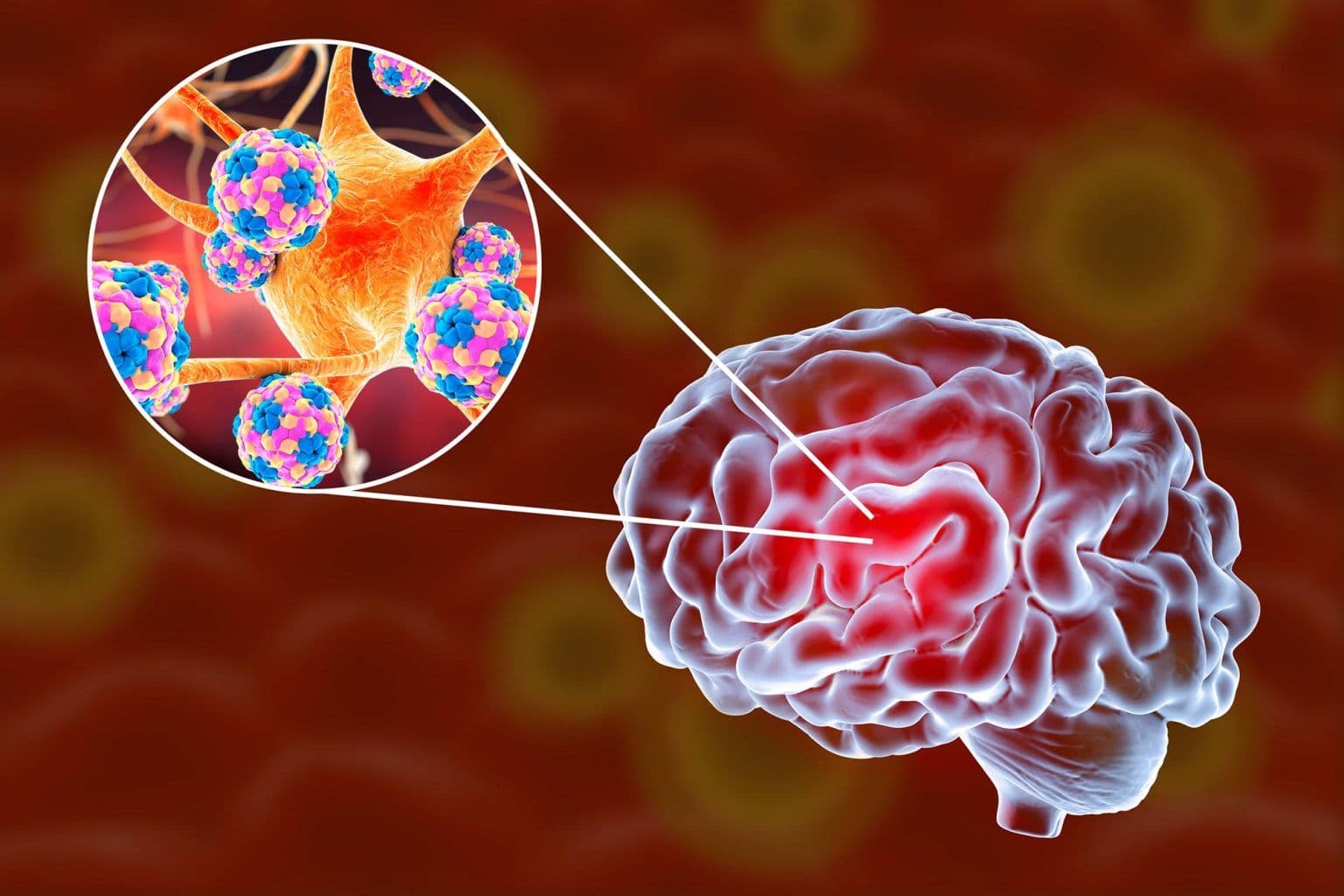 In Rare Cases, Measles Mutates in Brain and Kills